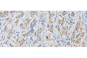 Immunohistochemistry of paraffin-embedded Human liver cancer tissue using PLA2G15 Polyclonal Antibody at dilution of 1:65(x200) (PLA2G15 抗体)