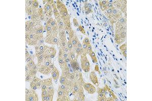 Immunohistochemistry of paraffin-embedded human liver cancer using ALG2 Antibody. (ALG2 抗体)