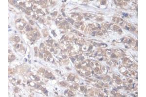 DAB staining on IHC-P; Samples: Human Breast cancer Tissue (ELMO2 抗体  (AA 501-720))