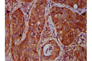 IHC image of ABIN7165140 diluted at 1:500 and staining in paraffin-embedded human cervical cancer performed on a Leica BondTM system. (BICD2 抗体  (AA 511-625))