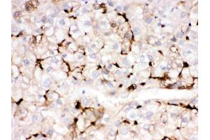 APOA1 was detected in paraffin-embedded sections of human liver cancer tissues using rabbit anti- APOA1 Antigen Affinity purified polyclonal antibody (Catalog # ) at 1 µg/mL. (APOA1 抗体  (AA 25-267))