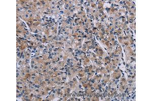 Immunohistochemistry of Human prostate cancer using KDM4D Polyclonal Antibody at dilution of 1:50 (JMJD2D 抗体)