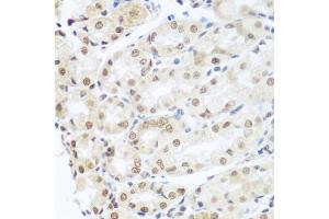 Immunohistochemistry of paraffin-embedded human gastric cancer using SNAI1 antibody (ABIN5975364) at dilution of 1/100 (40x lens).
