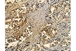 ABIN7094909 and ABIN7098963 at 1/100 staining human pancreatic cancer by IHC-P. (IL23 抗体)