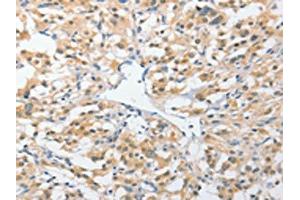 The image on the left is immunohistochemistry of paraffin-embedded Human thyroid cancer tissue using ABIN7131538(UCHL5 Antibody) at dilution 1/25, on the right is treated with fusion protein. (UCHL5 抗体)