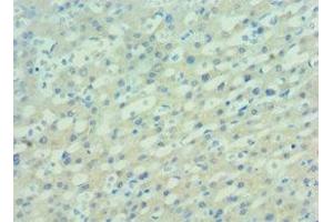 Immunohistochemistry of paraffin-embedded human lung cancer using ABIN7162506 at dilution of 1:100 (PAX7 抗体  (AA 291-520))