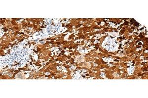 Immunohistochemistry of paraffin-embedded Human cervical cancer tissue using FGD3 Polyclonal Antibody at dilution of 1:50(x200) (FGD3 抗体)