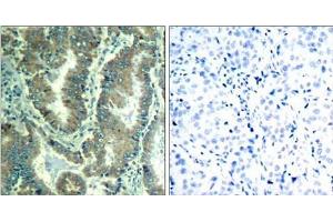 Immunohistochemical analysis of paraffin-embedded human lung carcinoma tissue using α -catenin (Ab-177) Antibody (E021521). (CTNNA1 抗体)