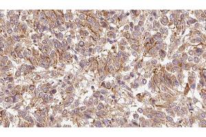 ABIN6278955 at 1/100 staining Human Melanoma tissue by IHC-P. (WNT6 抗体  (Internal Region))