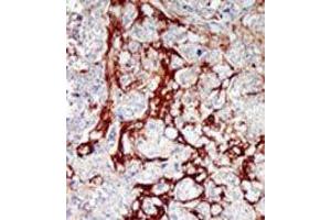 Formalin-fixed and paraffin-embedded human cancer tissue reacted with the primary antibody, which was peroxidase-conjugated to the secondary antibody, followed by DAB staining. (CDKL1 抗体  (C-Term))