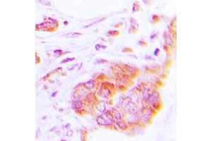 Immunohistochemical analysis of COX17 staining in human lung cancer formalin fixed paraffin embedded tissue section.