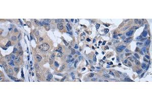 Immunohistochemistry of paraffin-embedded Human breast cancer tissue using PLK4 Polyclonal Antibody at dilution of 1:50(x200) (PLK4 抗体)