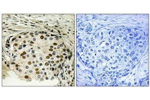 Immunohistochemical analysis of paraffin-embedded human breast carcinoma tissue using OSR1 (Phospho-Thr185) antibody (left)or the same antibody preincubated with blocking peptide (right). (OXSR1 抗体  (pThr185))