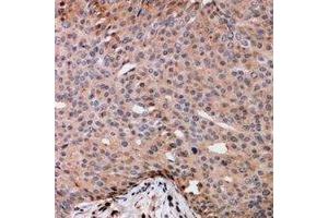 Immunohistochemical analysis of TRAK2 staining in human breast cancer formalin fixed paraffin embedded tissue section. (TRAK2 抗体)