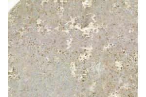 ABIN6257065 and ABIN6275006 at 1/100 staining human melanoma by IHC-P. (CLIC3 抗体  (N-Term))