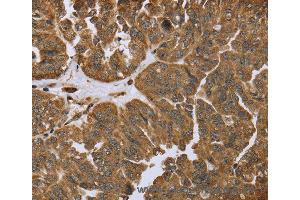 Immunohistochemistry of Human prostate cancer using IKBIP Polyclonal Antibody at dilution of 1:40 (IKbIP 抗体)