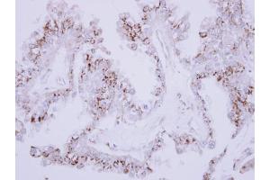 IHC-P Image Immunohistochemical analysis of paraffin-embedded OVCA xenograft, using CD75, antibody at 1:500 dilution. (ST6GAL1 抗体  (Center))