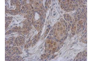 IHC-P Image Immunohistochemical analysis of paraffin-embedded Cal27 xenograft, using NDUFA12, antibody at 1:500 dilution. (NDUFA12 抗体  (full length))