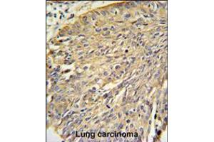 Annexin A1 Antibody IHC analysis in formalin fixed and paraffin embedded human lung carcinoma followed by peroxidase conjugation of the secondary antibody and DAB staining. (Annexin a1 抗体  (AA 129-158))
