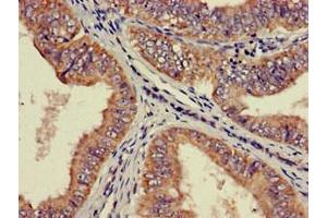 Immunohistochemistry of paraffin-embedded human endometrial cancer using ABIN7142516 at dilution of 1:100 (RPS21 抗体  (AA 1-81))