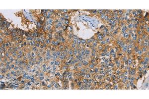 Immunohistochemistry of paraffin-embedded Human lung cancer using CDCP1 Polyclonal Antibody at dilution of 1:50 (CDCP1 抗体)