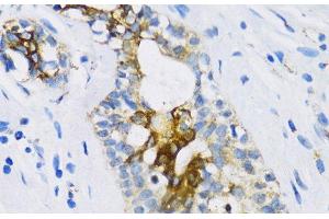 Immunohistochemistry of paraffin-embedded Human breast using PTCH1 Polyclonal Antibody at dilution of 1:100 (40x lens). (Patched 1 抗体)