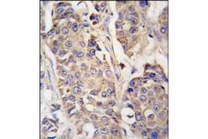 Formalin-fixed and paraffin-embedded human breast carcinoma tissue reacted with ACO2 antibody (Center), which was peroxidase-conjugated to the secondary antibody, followed by DAB staining. (ACO2 抗体  (Middle Region))