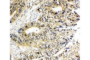 IHC-P: NME2 antibody testing of human intestinal cancer tissue (NME2 抗体  (AA 137-152))