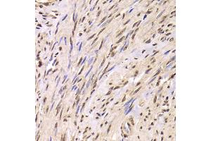 Immunohistochemistry of paraffin-embedded human adenomyosis using SNRPA Antibody (ABIN5973811) at dilution of 1/100 (40x lens). (SNRPA1 抗体)