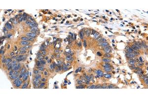 Immunohistochemistry of paraffin-embedded Human colon cancer using FADD Polyclonal Antibody at dilution of 1:35 (FADD 抗体)