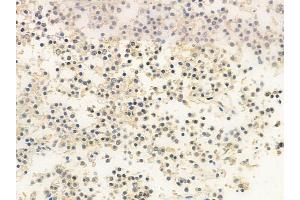 ABIN6258864 and ABIN6273547 at 1/100 staining human pituitary adenoma by IHC-P.