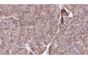 ABIN6273289 at 1/100 staining Human pancreas cancer tissue by IHC-P. (PCMT1 抗体  (Internal Region))