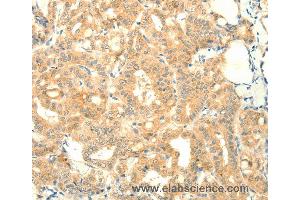 Immunohistochemistry of Human thyroid cancer using SNAP25 Polyclonal Antibody at dilution of 1:25 (SNAP25 抗体)