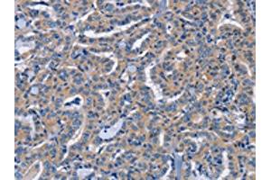 The image on the left is immunohistochemistry of paraffin-embedded Human thyroid cancer tissue using ABIN7191592(NCR2 Antibody) at dilution 1/60, on the right is treated with synthetic peptide. (NKp44/NCR2 抗体)