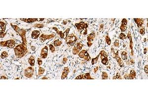 Immunohistochemistry of paraffin-embedded Human liver cancer tissue using SAA1 Polyclonal Antibody at dilution of 1:70(x200) (SAA1 抗体)