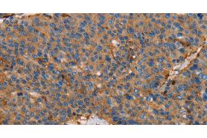 Immunohistochemistry of paraffin-embedded Human liver cancer using ACTA1 Polyclonal Antibody at dilution of 1:65 (Actin 抗体)