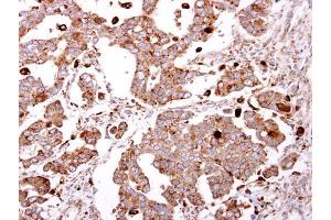 IHC-P Image beta-Gal antibody [N2C3] detects beta-Gal protein at cytosol on human ovarian carcinoma by immunohistochemical analysis. (GLB1 抗体)