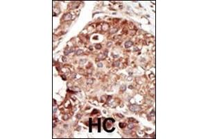 Formalin-fixed and paraffin-embedded human cancer tissue reacted with the primary antibody, which was peroxidase-conjugated to the secondary antibody, followed by DAB staining. (PEBP1 抗体  (AA 137-167))