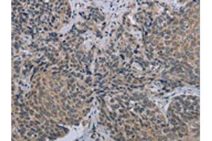 The image on the left is immunohistochemistry of paraffin-embedded Human cervical cancer tissue using ABIN7191408(MARVELD1 Antibody) at dilution 1/40, on the right is treated with synthetic peptide. (MARVELD1 抗体)