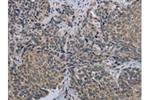 The image on the left is immunohistochemistry of paraffin-embedded Human cervical cancer tissue using ABIN7191408(MARVELD1 Antibody) at dilution 1/40, on the right is treated with synthetic peptide.