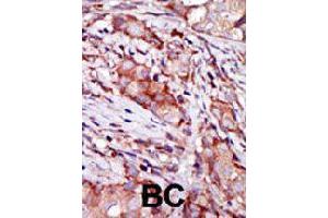 Formalin-fixed and paraffin-embedded human breast cancer tissue reacted with CIB2 polyclonal antibody  , which was peroxidase-conjugated to the secondary antibody, followed by AEC staining. (CIB2 抗体  (N-Term))