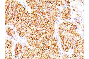 Formalin-fixed, paraffin-embedded human Renal Cell Carcinoma stained with RCC Mouse Monoclonal Antibody (66. (CA9 抗体)