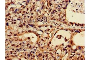 Immunohistochemistry of paraffin-embedded human lung cancer using ABIN7162924 at dilution of 1:100