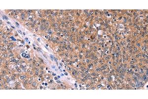 Immunohistochemistry of paraffin-embedded Human ovarian cancer tissue using EDN1 Polyclonal Antibody at dilution 1:50 (Endothelin 1 抗体)