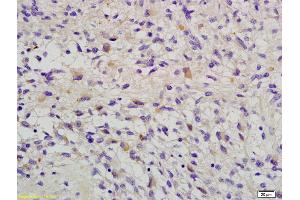 Formalin-fixed and paraffin embedded human glioma labeled with Anti-RAB-14 Polyclonal Antibody, Unconjugated (ABIN681898) at 1:200 followed by conjugation to the secondary antibody and DAB staining (RAB14 抗体  (AA 21-120))