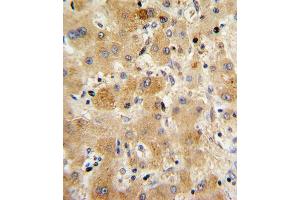 Formalin-fixed and paraffin-embedded human hepatocarcinoma with TTR Antibody (Center), which was peroxidase-conjugated to the secondary antibody, followed by DAB staining. (TTR 抗体  (AA 47-74))