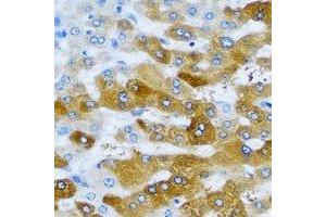 Immunohistochemical analysis of IMPA1 staining in human liver cancer formalin fixed paraffin embedded tissue section. (IMPA1 抗体)