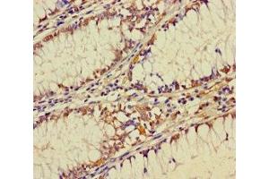 Immunohistochemistry of paraffin-embedded human colon cancer using ABIN7176193 at dilution of 1:100 (ZNF26 抗体  (AA 1-200))