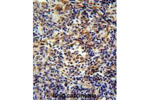 CASKIN2 antibody(Center) immunohistochemistry analysis in formalin fixed and paraffin embedded human lung carcinoma followed by peroxidase conjugation of the secondary antibody and DAB staining. (CASKIN2 抗体  (Middle Region))