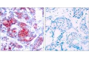 Immunohistochemistry analysis of paraffin-embedded human breast carcinoma, using STAT4 (Phospho-Tyr693) Antibody. (STAT4 抗体  (pTyr693))